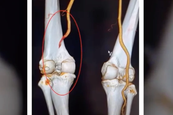 Giữ chân cho bệnh nhân Phú Thọ bị đứt mạch máu khoeo