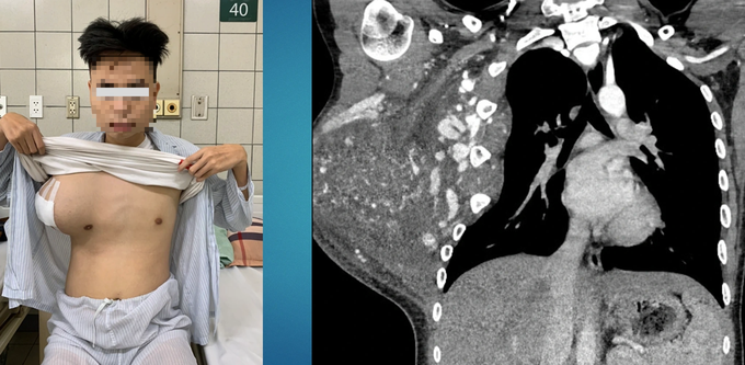 Khối u kéo lệch lồng ngực, ăn rộng ra bả vai. - Ảnh: dantri.