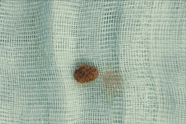 Bé 9 tuổi đau quặn thận do sỏi niệu quản, khuyến cáo khi trẻ đau bụng