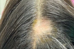 Rụng tóc từng mảng tăng nguy cơ mắc bệnh lý tâm thần