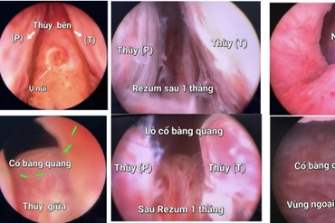 Kỹ thuật chữa bệnh lý tuyến tiền liệt 'xịn' nhất hiện nay