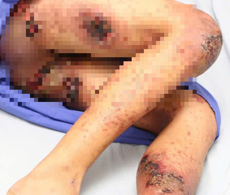 Đắp kiến ba khoang chữa ngứa, thanh niên 25 tuổi bị tổn thương da toàn thân - Ảnh BVCC