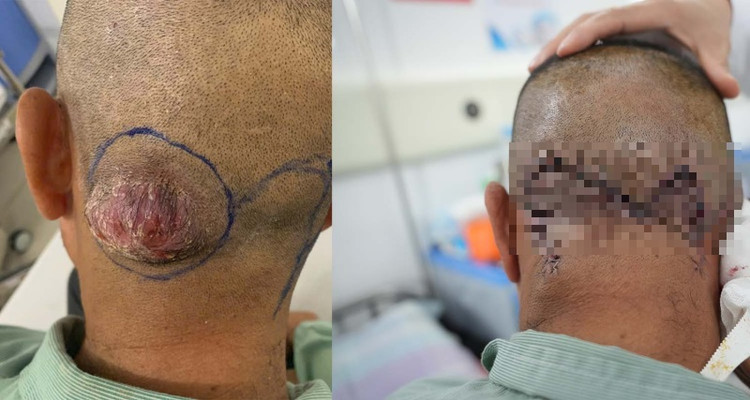 Khối u sùi da đầu vùng chẩm trước và sau phẫu thuật tại Bệnh viện Bãi Cháy - Ảnh BVCC