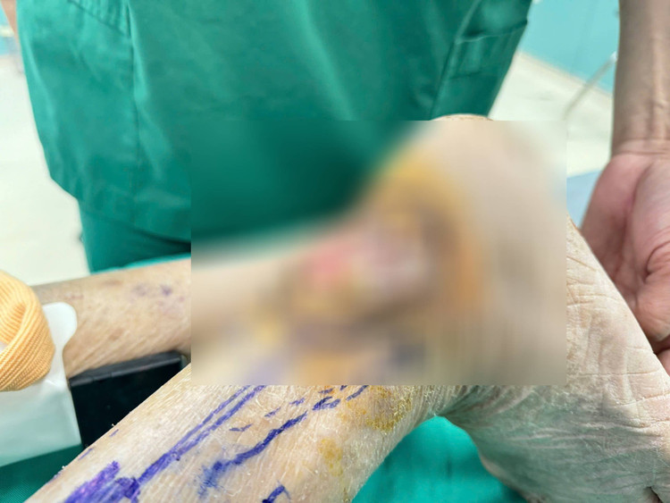 Tái tạo vết thương lở loét cả năm sau nhiều lần phẫu thuật do chó cắn - Ảnh BVCC