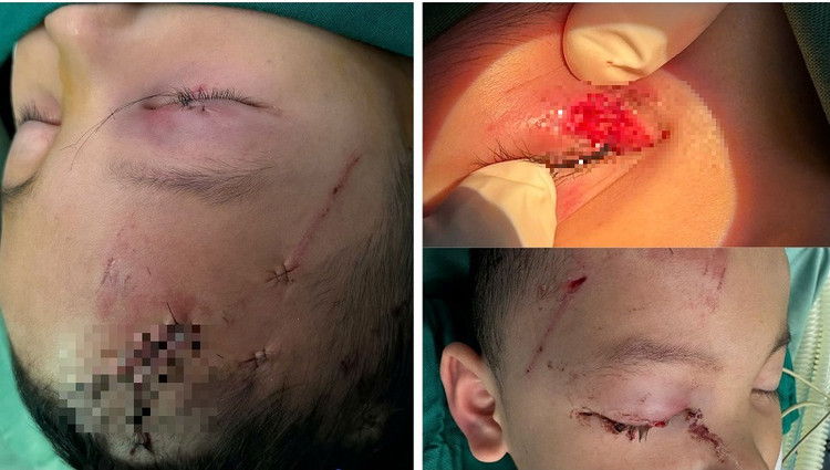 Tổn thương chó cắn ở trẻ - Ảnh BVCC