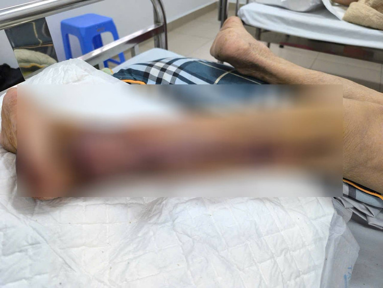 Lấy da từ bắp chân để tạo hình cho bệnh nhân - Ảnh BVCC