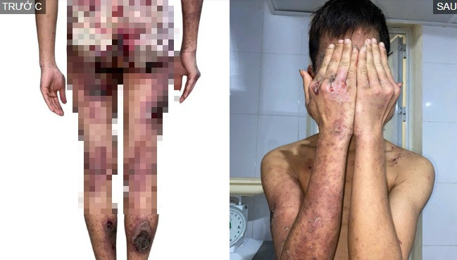 Đắp kiến ba khoang chữa ngứa, thanh niên 25 tuổi bị tổn thương da toàn thân - Ảnh BVCC