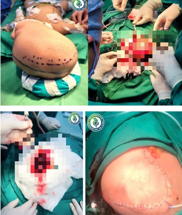 Ca phẫu thuật lấy máu tụ cho bệnh nhi tại Bệnh viện Trẻ em Hải Phòng - Ảnh BVCC