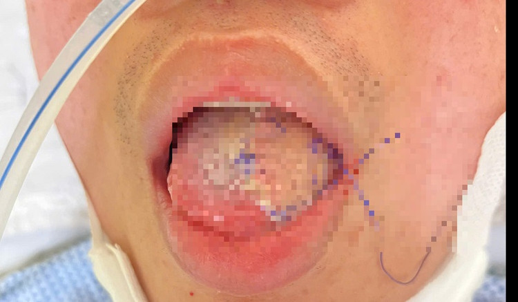 Lưỡi của bệnh nhân sau khi được phẫu thuật cắt bỏ khối u và tái tạo. Ảnh: BVCC. Lưỡi của bệnh nhân sau khi được phẫu thuật cắt bỏ khối u và tái tạo. Ảnh: BVCC.