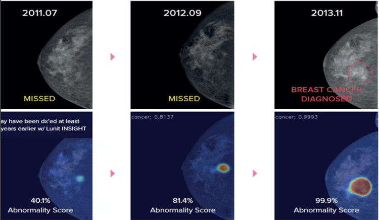 Phát hiện ung thư vú sớm hơn 2 năm nhờ AI chỉ ra điểm bất thường và tỷ lệ nghi ngờ