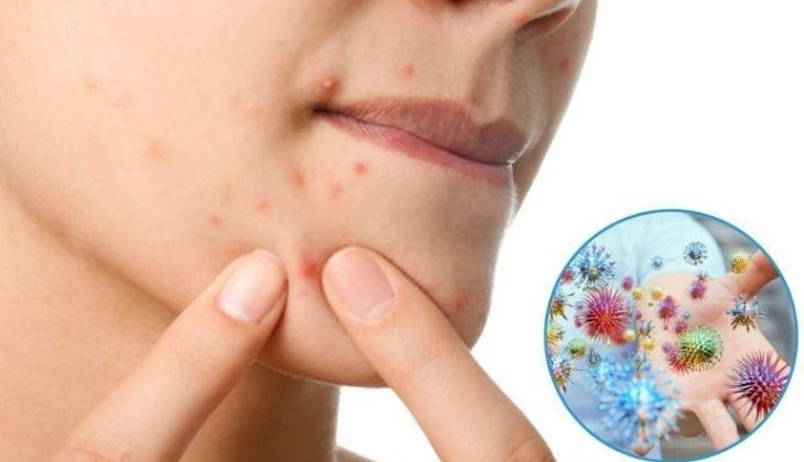 Nặn mụn không đúng cách.