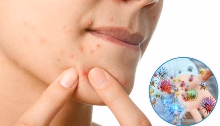 Nặn mụn không đúng cách.