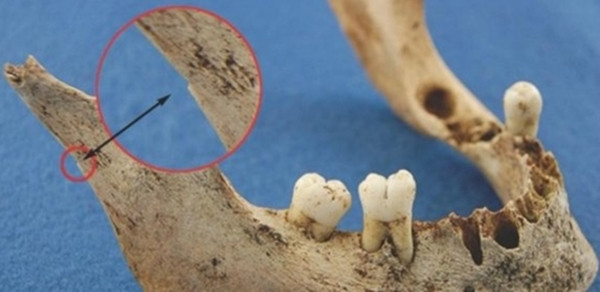 Dấu vết cắt xẻo trên xương hàm của thuyền trưởng James Fitzjames.