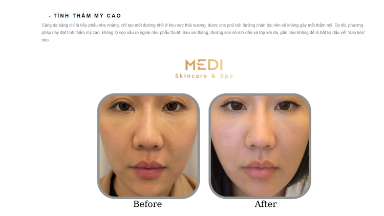 Mục &quot;Tin tức&quot; trên website https://mediskincare.vn vẫn còn bài viết quảng cáo về dịch vụ &quot;Căng da mặt bằng chỉ collagen&quot; - Ảnh chụp màn hình.