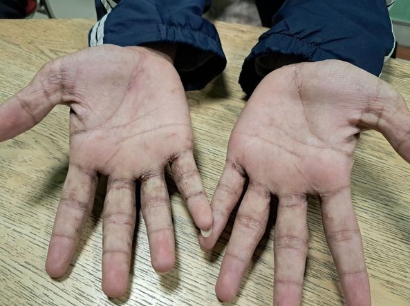 Biểu hiện ghẻ trên da của bệnh nhân