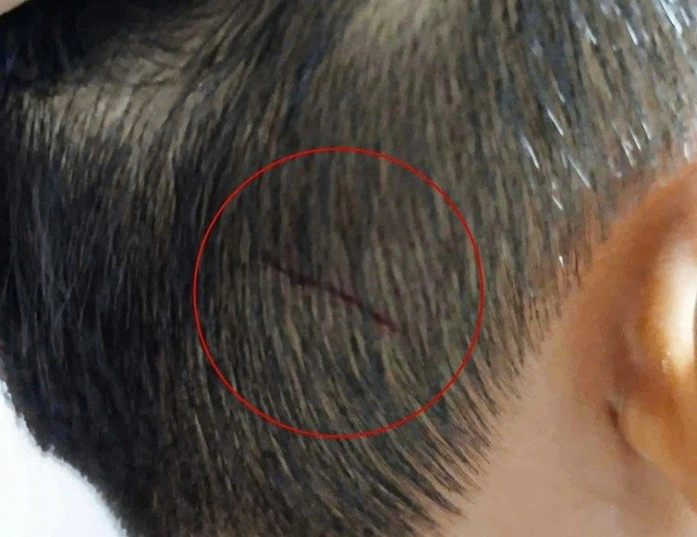Vết thương trên vùng đầu bé tra Đ.N.A.K sau bị đánh chảy máu. Ảnh Gia đình cung cấp