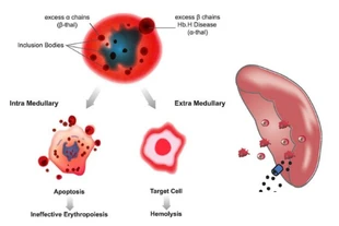 Phát hiện bé 19 tháng tuổi mắc thalassemia thể HbH nhờ xét nghiệm gen
