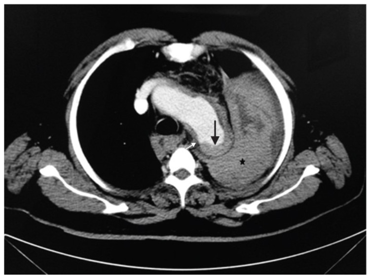 Kết quả chụp CT cho thấy bệnh nhân bị vỡ phình động mạch chủ. Ảnh BSCC