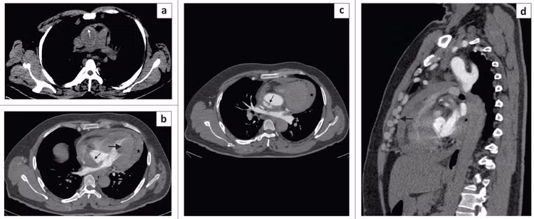 Kết quả chụp CT cho thấy bệnh nhân bị vỡ phình động mạch chủ. Ảnh BSCC