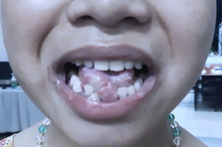 Bệnh nhi bị gãy nhiều răng trong quá trình phát bệnh. Ảnh BVCC