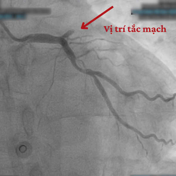 Hình ảnh trên thiết bị can thiệp
