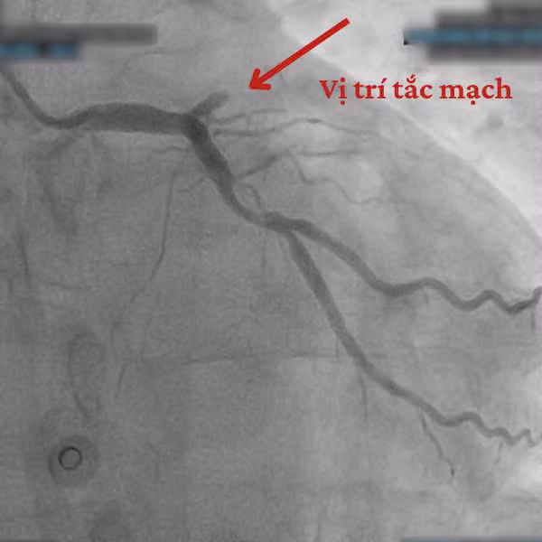 Hình ảnh trên thiết bị can thiệp