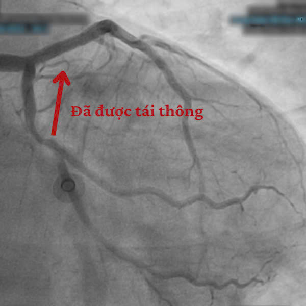 Hình ảnh trên thiết bị can thiệp