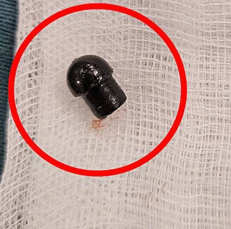 Dị vật đầu bút được gắp ra từ đường thở của bệnh nhi. Ảnh BVCC Dị vật đầu bút được gắp ra từ đường thở của bệnh nhi. Ảnh BVCC
