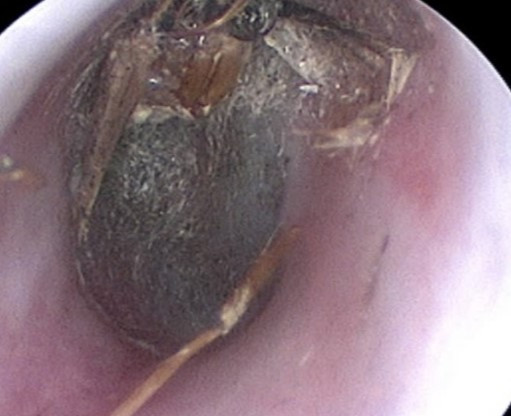 Hình ảnh nội soi tai thấy con bướm chết dính vào màng nhĩ bà P. Ảnh: BVCC