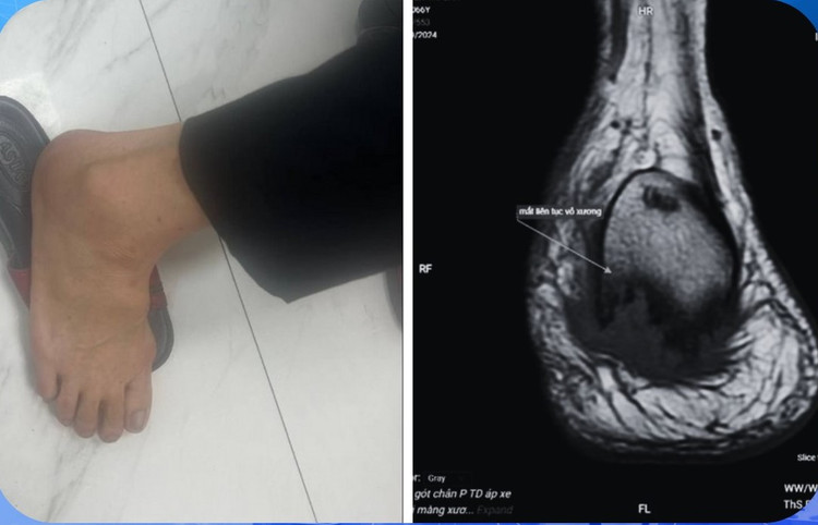 Đau gót chân, uống thuốc không khỏi đi khám phát hiện viêm xương tủy. Ảnh BVCC