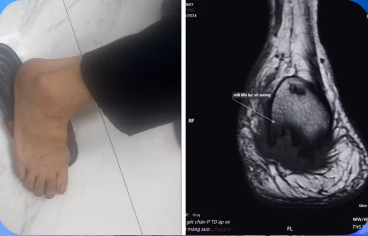 Đau gót chân, uống thuốc không khỏi đi khám phát hiện viêm xương tủy. Ảnh BVCC