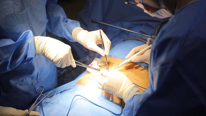 Các bác sĩ phẫu thuật nội soi đặt mảnh ghép nhân tạo vào thành bụng điều trị thoát vị rốn cho bệnh nhân T. Ảnh: BVCC