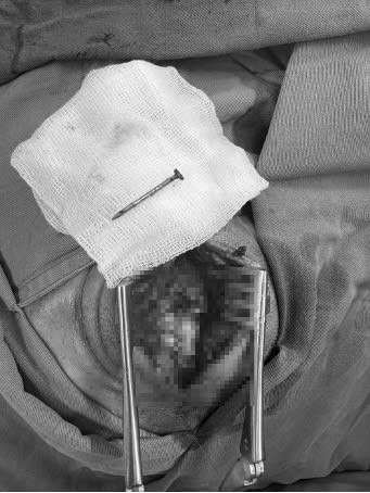 Kíp y bác sĩ Khoa Ngoại Thần kinh đã phẫu thuật mở sọ và lấy thành công dị vật là cây đinh dài khoảng 5cm ra khỏi đầu bệnh nhân