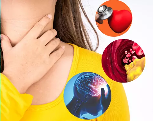 Người mắc suy giáp có nguy cơ bị suy tim, xơ vữa động mạch, đột quỵ