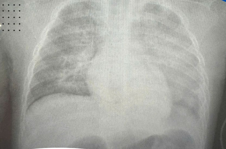Phim X-quang phổi bệnh nhi. Ảnh BVCC