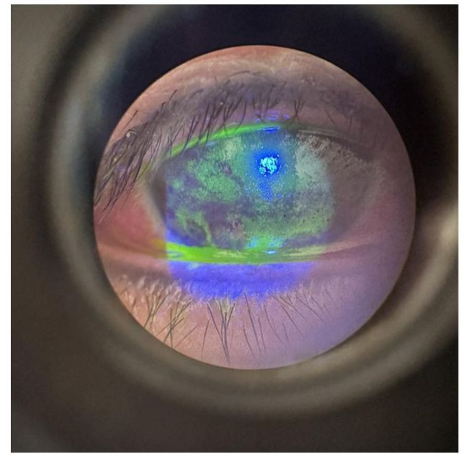 Tình trạng mắt của bệnh nhân lúc vào viện. Ảnh: TTYT huyện Thanh Sơn