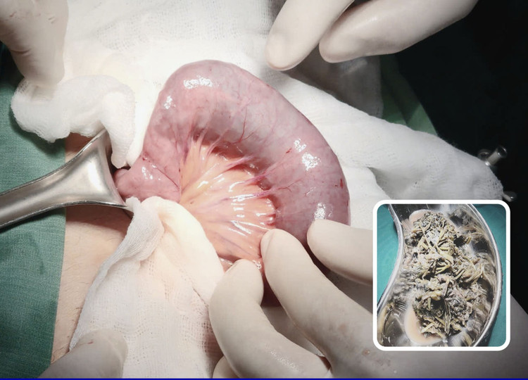 Bệnh nhân bị tắc ruột non do viêm dính, tắc nghẽn bởi bã thức ăn. Ảnh BVCC