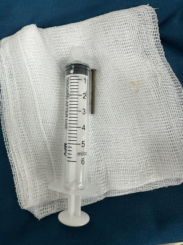 Ê-kíp nội soi tiêu hóa đã gắp cây đinh sắt 3 cm trong tá tràng bé trai 6 tuổi.