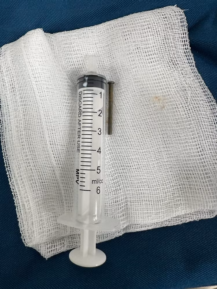 Ê-kíp nội soi tiêu hóa đã gắp cây đinh sắt 3 cm trong tá tràng bé trai 6 tuổi.