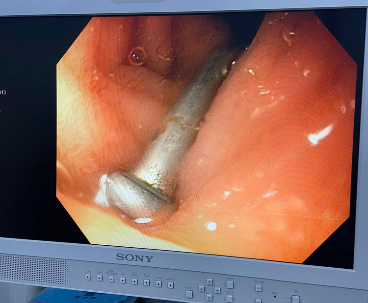 Nội soi phát hiện đinh sắt dài 3 cm nằm trong tá tràng của bệnh nhi. Ảnh BVCC