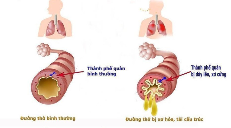 Viêm phổi tắc nghẽn mạn tính (COPD) đang trở thành gánh nặng về y tế trên toàn cầu
