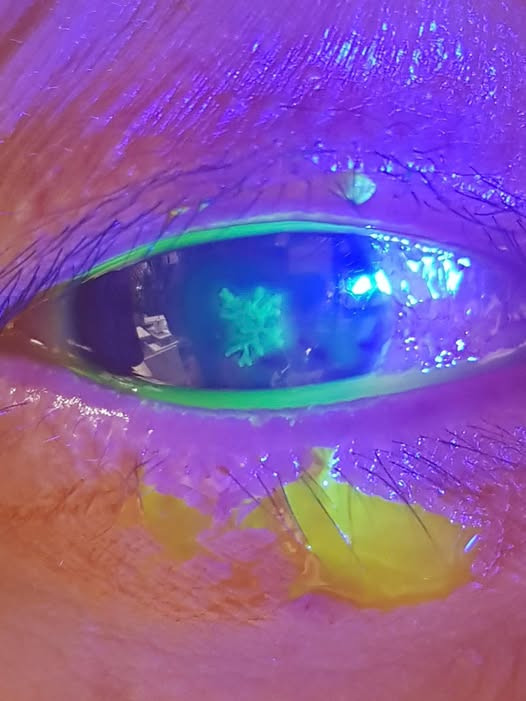 Hình ảnh mắt bệnh nhân nhiễm Herpes. Ảnh BVCC