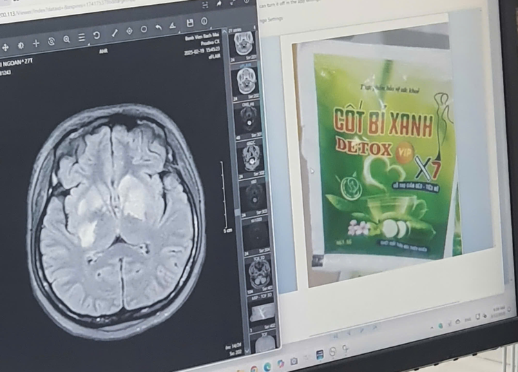 Hình ảnh não bị tổn thương và thực phẩm chức năng người phụ nữ uống. Ảnh Vietnamnet