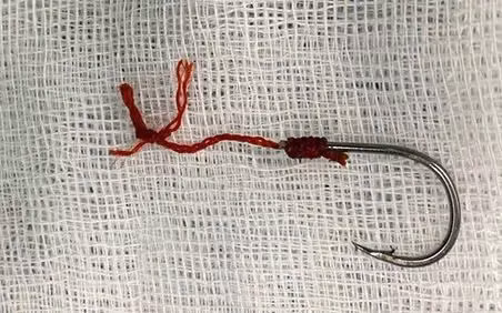 Dị vật lưỡi câu trong hậu môn bệnh nhân. Ảnh BVCC Dị vật lưỡi câu trong hậu môn bệnh nhân. Ảnh BVCC