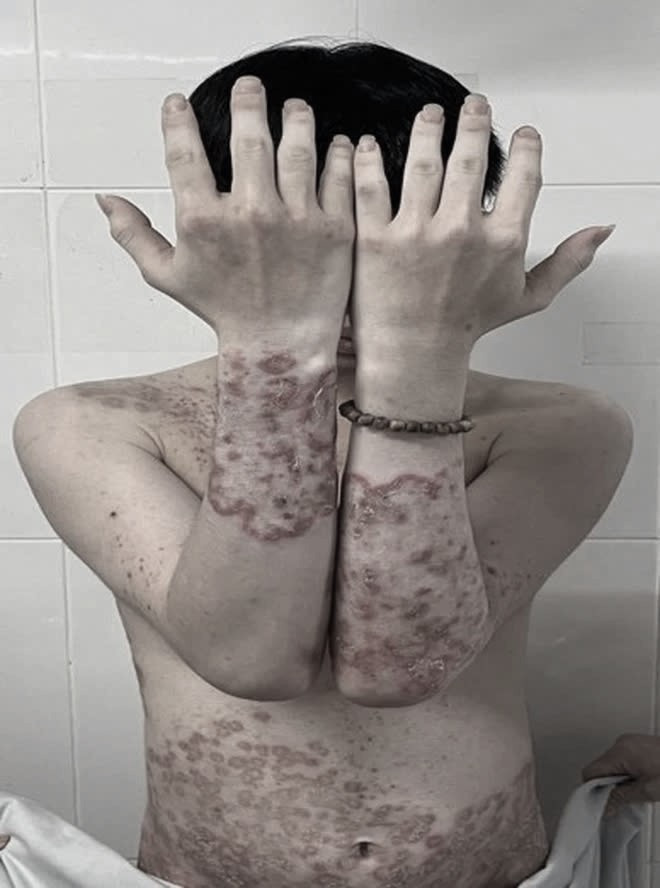 Dát, mảng đỏ hình tròn, đa cung ở tay, thân mình. Ảnh: SK&amp;ĐS