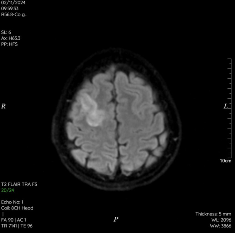 Kết quả chụp CT bệnh nhân được chẩn đoán Huyết khối tĩnh mạch vỏ não vùng đỉnh 2 bên và phần trước xoang dọc trên. Ảnh BVCC