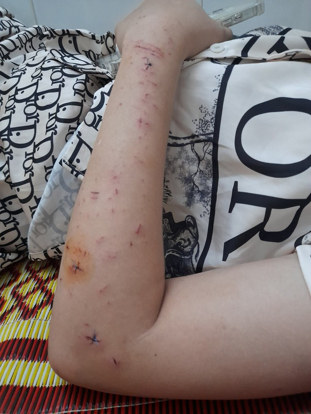 Vết thương chị L. bị chồng cũ đánh. Ảnh baocongluan