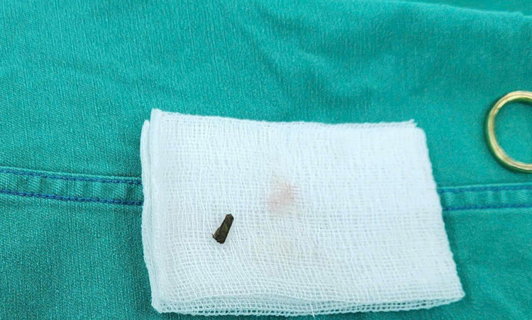 Dị vật lấy ra từ mu bàn chân của bệnh nhi. Ảnh BVCC