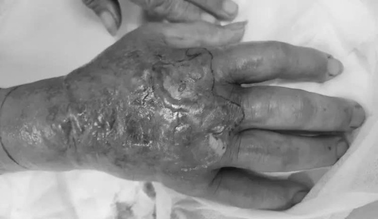 Một bệnh nhân bị hoại tử nhiễm trùng bàn tay do rắn hổ mang cắn hiện đang được điều trị tại Trung tâm Chống độc. Ảnh Trung tâm Chống độc