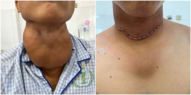 Nam thanh niên bị khối bướu giáp nặng 600gr chèn ép đường thở, nuốt khó. Ảnh BĐO Nam thanh niên bị khối bướu giáp nặng 600gr chèn ép đường thở, nuốt khó. Ảnh BĐO